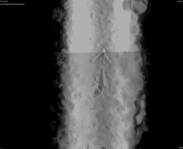 Artefakt- Schwertmarke im CT sichtbar